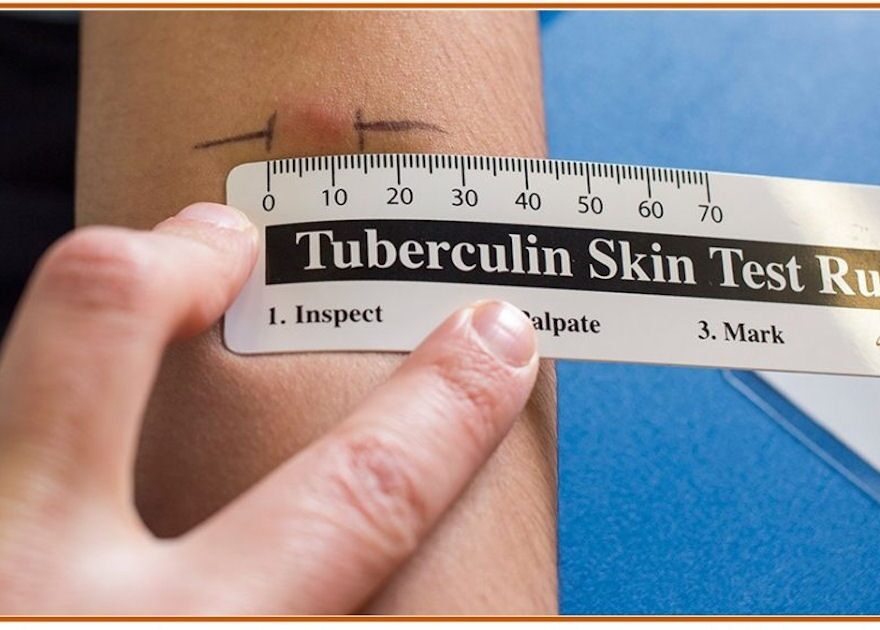 Free Mantoux Tuberculin Skin Testing Ruler