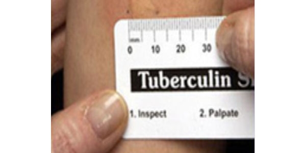 Printable Mantoux Tuberculin Skin Testing Rulers